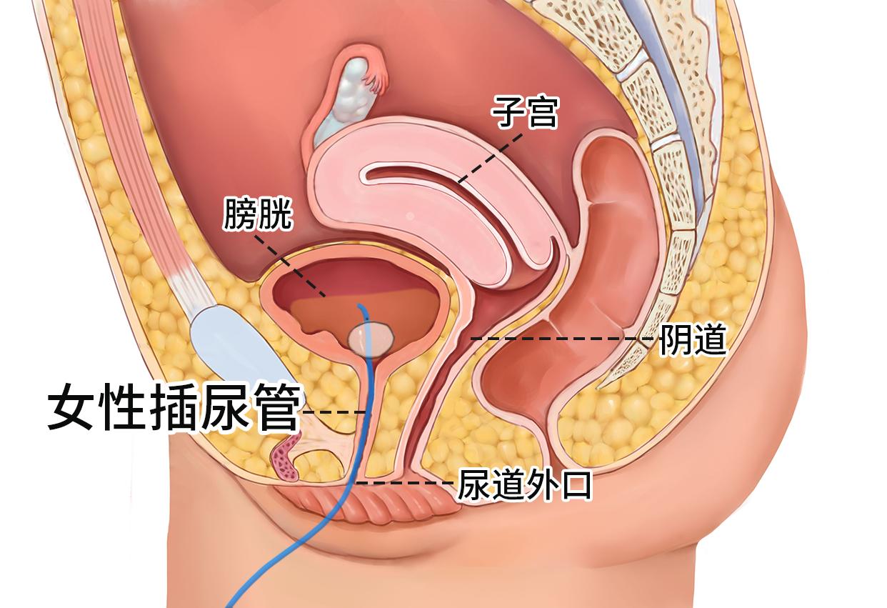导尿-1